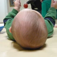 plagiocephaly أو عدم تماثل الجمجمة