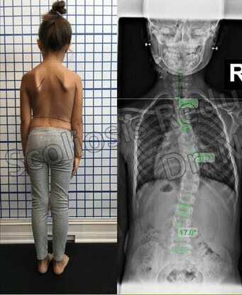 هل يمكن للطفل المصاب باعوجاج العمود الفقري أن يعيش حياة طبيعية؟