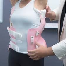 متى يفقد الانحناء تصحيحه بعد إزالة حزام اعوجاج العمود الفقري لدى المراهقين؟