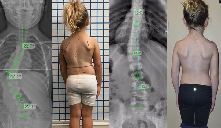 8 طرق يؤثر بها اعوجاج العمود الفقري على جسم طفلك: اكتشف تأثيرها وكيف تحمي صحته