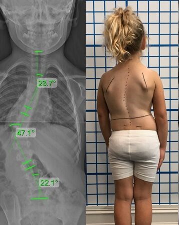 تشوّهات العمود الفقري عند الأطفال: كيف تؤثر على النمو والقفص الصدري