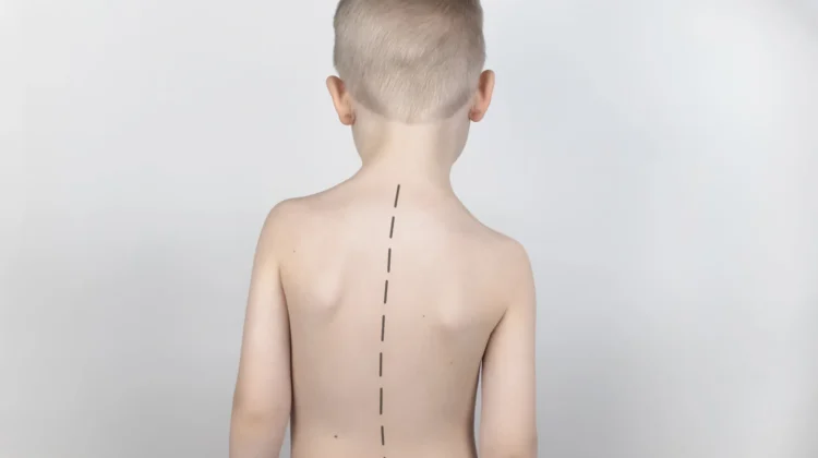 لماذا يصعب اكتشاف اعوجاج العمود الفقري مبكرًا عند الأطفال؟ أهم الأسباب والعلامات المبكرة