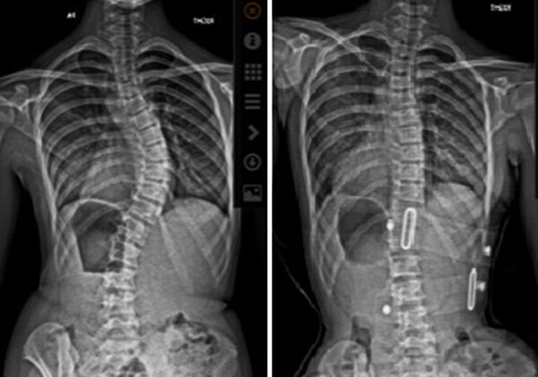 عوامل خفية تحدد نجاح حزام اعوجاج العمود الفقري: ما يجب أن يعرفه كل والد