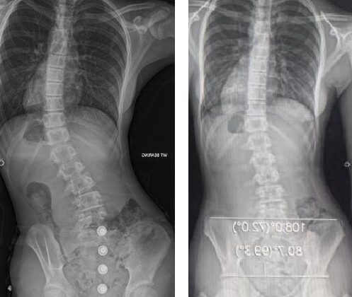 معدل التصحيح الأولي لحزام اعوجاج العمود الفقري: مفتاح التنبؤ بنجاح العلاج لدى المراهقين