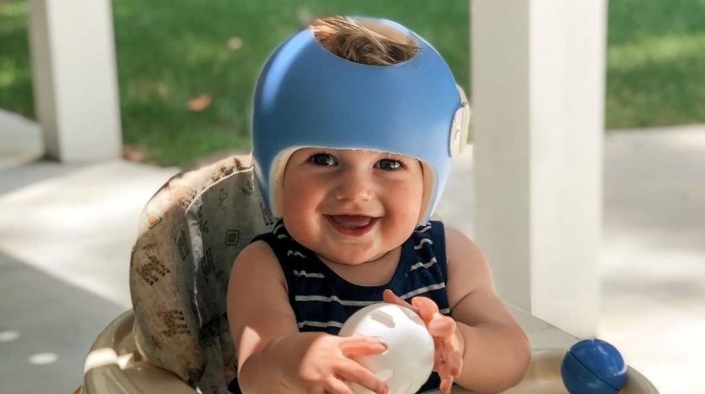 خوذة علاج الرأس المسطح للأطفال: لماذا تثير الجدل؟ ولماذا تختلف المشاهدات حولها