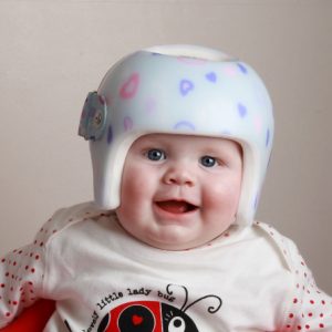 متى لا تفيد خوذة علاج الرأس المسطح؟ ويمكن الاستغناء عنها