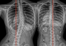 علاج اعوجاج العمود الفقري (الجنف): أي برنامج علاجي هو الأنسب لطفلك بدون جراحة؟
