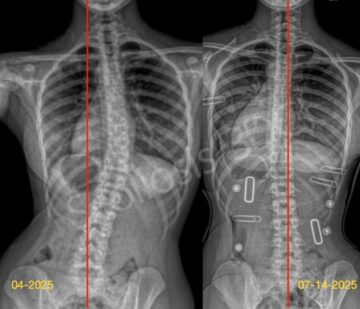 علاج اعوجاج العمود الفقري (الجنف): أي برنامج علاجي هو الأنسب لطفلك بدون جراحة؟