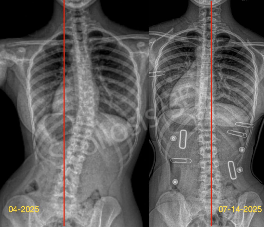 علاج اعوجاج العمود الفقري (الجنف): أي برنامج علاجي هو الأنسب لطفلك بدون جراحة؟