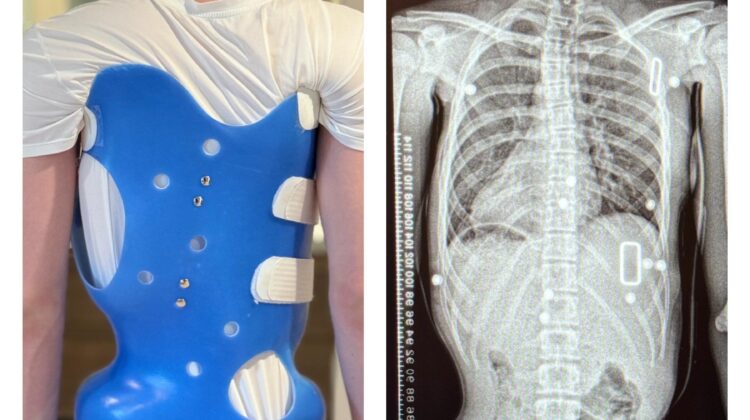 فترة التوقف عن حزام اعوجاج العمود الفقري: ماذا يحدث لجسم طفلك خلالها وكيف تحميه؟