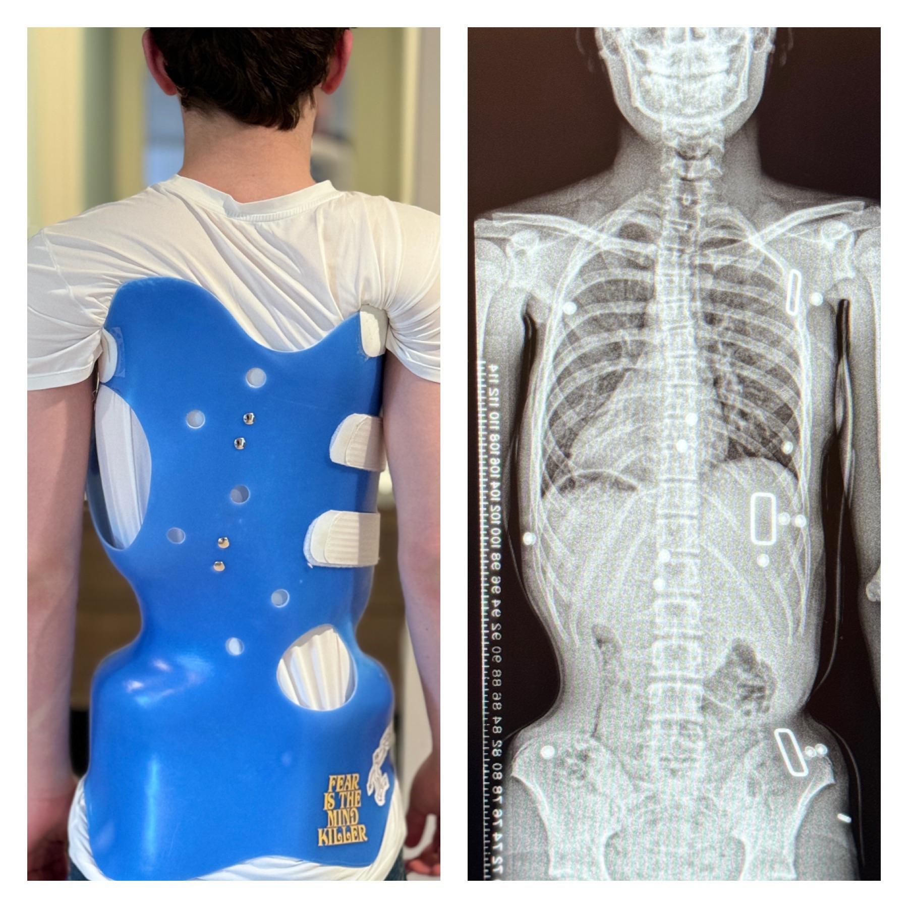 فترة التوقف عن حزام اعوجاج العمود الفقري: ماذا يحدث لجسم طفلك خلالها وكيف تحميه؟