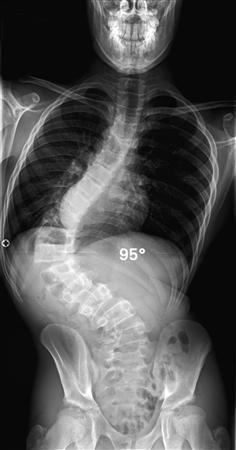 اعوجاج العمود الفقري مع ترنّح فريدريخ عند الأطفال | دليلك للتشخيص والعلاج