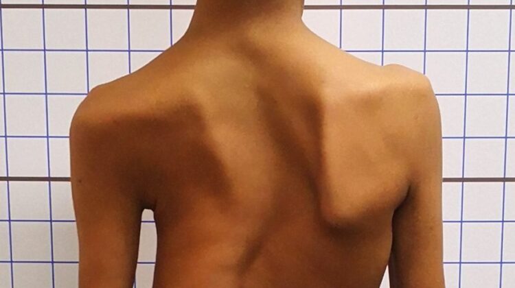 هل اعوجاج العمود الفقري طبيعي؟ اليك الفرق بين الانحناء الطبيعي والمرضي