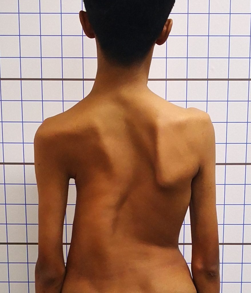 هل اعوجاج العمود الفقري طبيعي؟ اليك الفرق بين الانحناء الطبيعي والمرضي