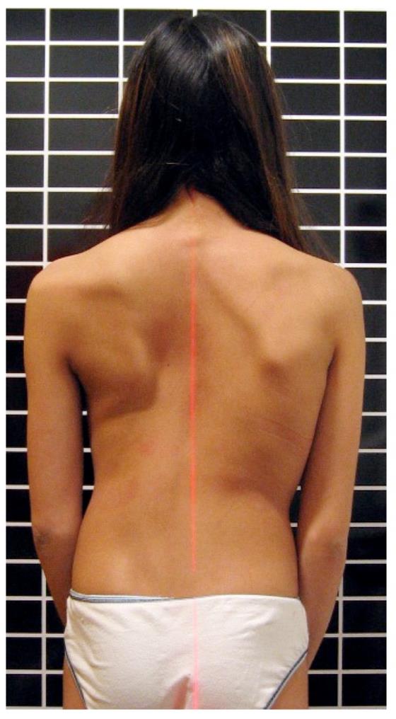 ما الذي لا يستطيع المصابون بالجنف فعله؟ دليلك لفهم حدود العمود الفقري والحياة اليومية