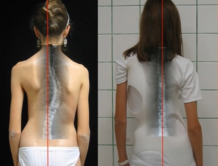 حزام اعوجاج العمود الفقري: كيف يطبق الضغط التصحيحي لتقويم الانحناء