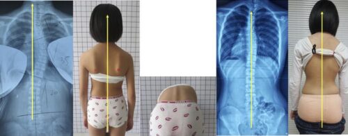 حزام اعوجاج العمود الفقري