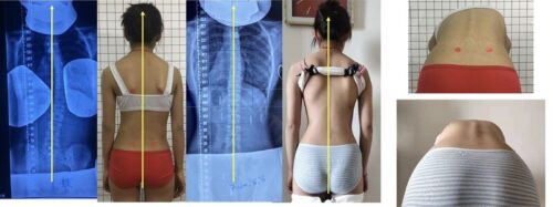 هل يكون الاعوجاج دائمًا بسبب تشوهات في الفقرات؟