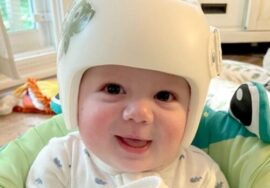 خوذة تصحيح شكل الرأس للرضع: خرافات شائعة يجب أن يتوقف الأهل عن تصديقها