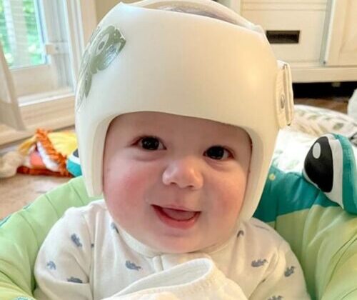 خوذة تصحيح شكل الرأس للرضع: خرافات شائعة يجب أن يتوقف الأهل عن تصديقها