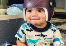 خوذة تعديل شكل الرأس عند الرضع: كيف تعمل ومتى يبدأ طفلك العلاج لتحقيق أفضل النتائج؟