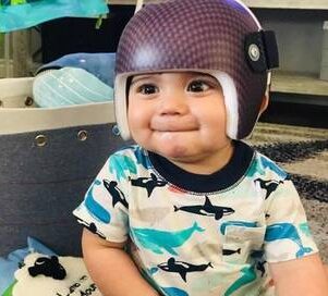 خوذة تعديل شكل الرأس عند الرضع: كيف تعمل ومتى يبدأ طفلك العلاج لتحقيق أفضل النتائج؟