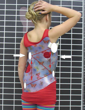  حزام اعوجاج العمود الفقري الذهبي : ما هو وكيف يحقق أفضل النتائج لطفلك