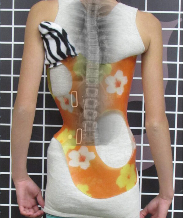 استخدام حزام اعوجاج العمود الفقري الجديد دليل شامل للأهل