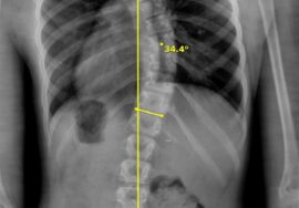 ما هي زاوية كوب التي يُشخَّص عندها اعوجاج العمود الفقري؟
