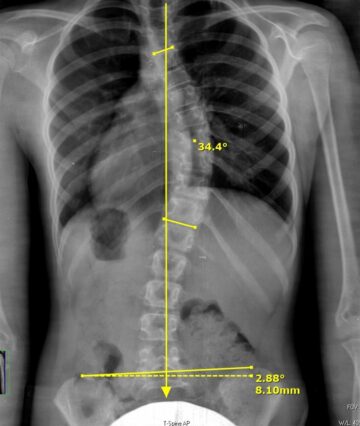 ما هي زاوية كوب التي يُشخَّص عندها اعوجاج العمود الفقري؟