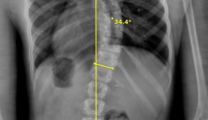 ما هي زاوية كوب التي يُشخَّص عندها اعوجاج العمود الفقري؟