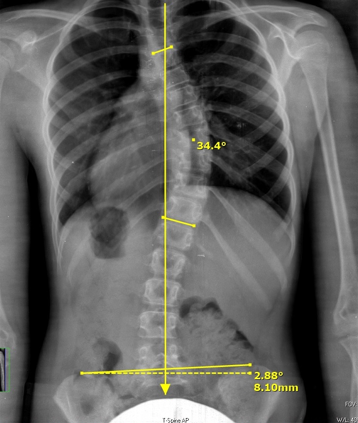 ما هي زاوية كوب التي يُشخَّص عندها اعوجاج العمود الفقري؟