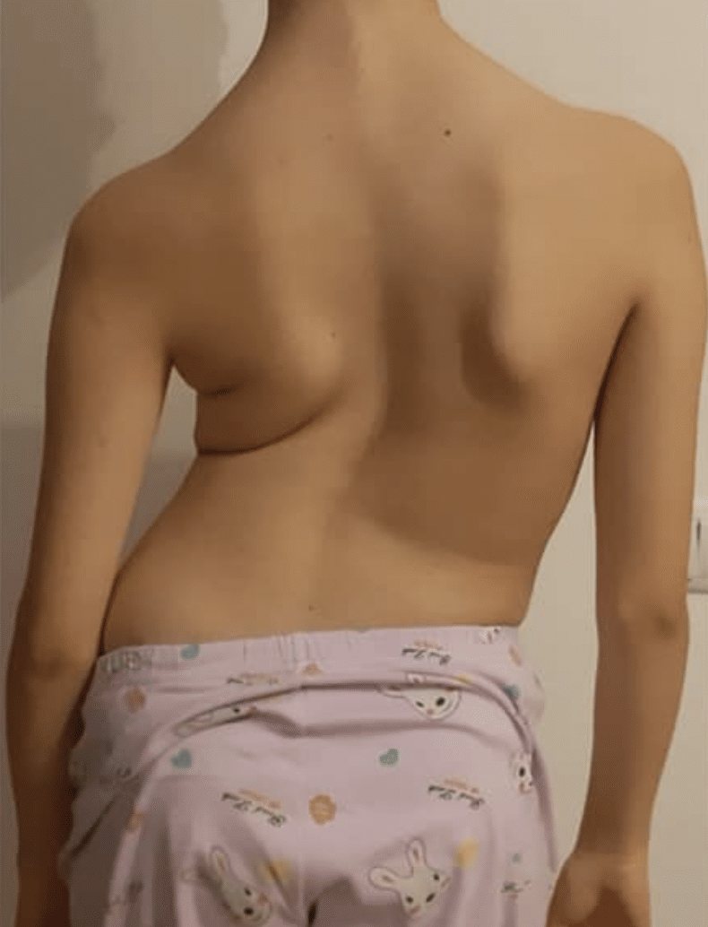 اعوجاج العمود الفقري الشديد عند الأطفال: مخاطر تركه دون علاج