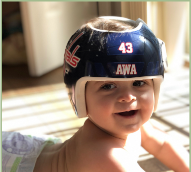 عوامل تزيد مدة العلاج بخوذة تصحيح شكل الرأس عند الرضع: كيف ولماذا قد يطول العلاج؟