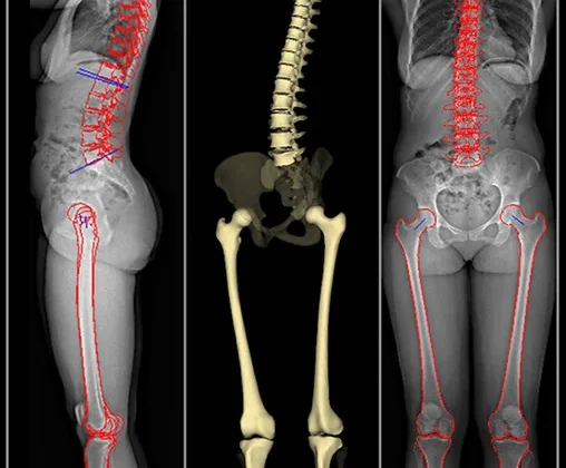أفضل فحص لتشخيص اعوجاج العمود الفقري : ثلاثي الأبعاد أم ثنائي الأبعاد لتحقيق نتائج دقيقة؟