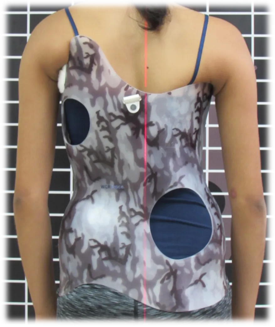 هل يحتاج طفلك لحزام اعوجاج العمود الفقري المخصص؟ إليك كل ما يجب معرفته