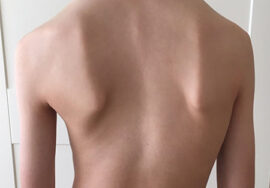 هل شكل الجذع يحدد نجاح حزام اعوجاج العمود الفقري لطفلك؟ إليك ما يجب معرفته