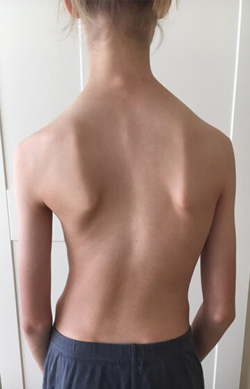 هل شكل الجذع يحدد نجاح حزام اعوجاج العمود الفقري لطفلك؟ إليك ما يجب معرفته