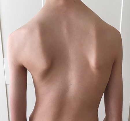 هل شكل الجذع يحدد نجاح حزام اعوجاج العمود الفقري لطفلك؟ إليك ما يجب معرفته