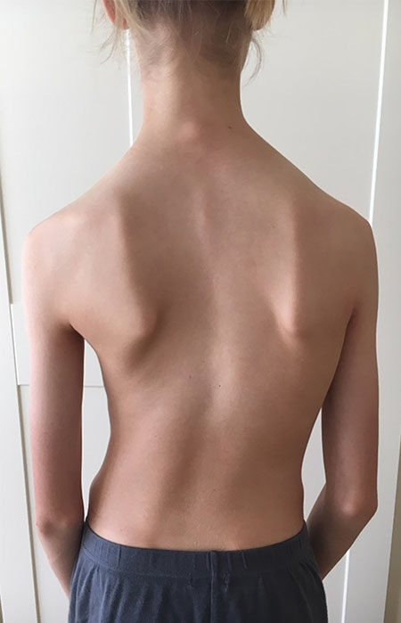 هل شكل الجذع يحدد نجاح حزام اعوجاج العمود الفقري لطفلك؟ إليك ما يجب معرفته