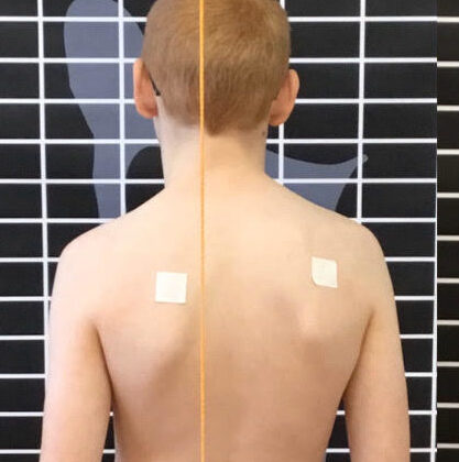 في أي عمر يصبح الجنف خطيرًا؟ دليلك لفهم المخاطر والتوقيت المناسب للعلاج