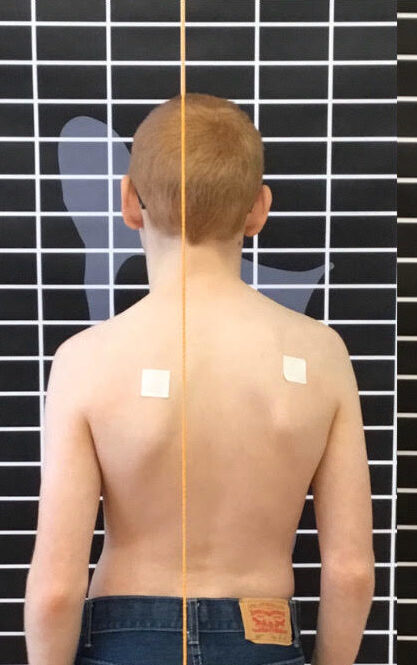 في أي عمر يصبح الجنف خطيرًا؟ دليلك لفهم المخاطر والتوقيت المناسب للعلاج