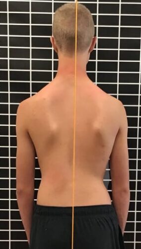 علامات الجنف