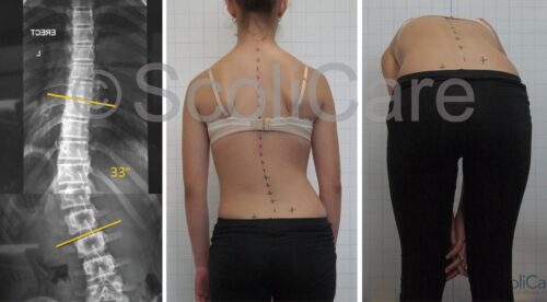  التنبؤ بتطور اعوجاج العمود الفقري