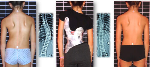 الحزام التصحيحي