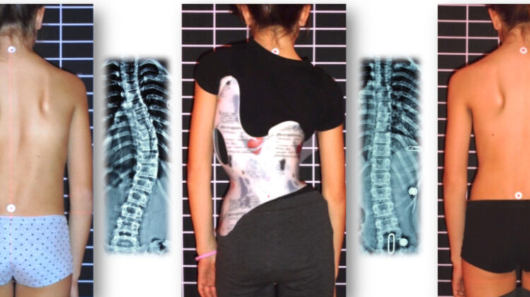 علاج اعوجاج العمود الفقري
