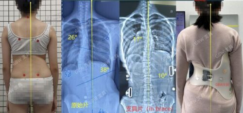 علاج الاعوجاج بدون جراحة