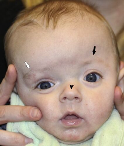 كيف يتم التشخيص الصحيح لتسطح الرأس؟