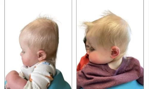 هل يتحسن تسطح الرأس تلقائيًا؟