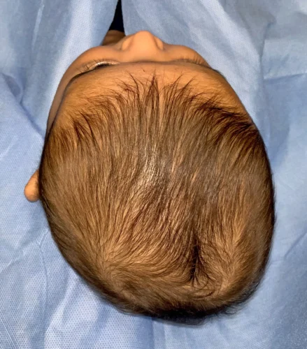 هل يتحسن تسطح الرأس تلقائيًا؟